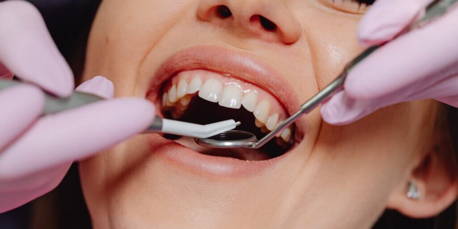 6 Important Facts About Root Canal Treatment in Brockville
