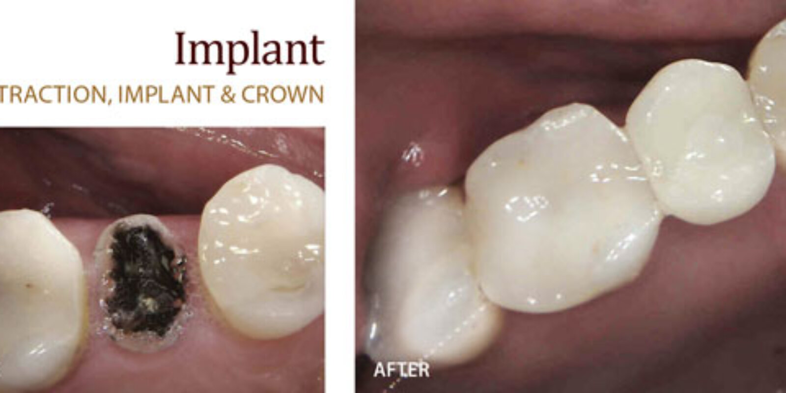 4 Reasons Why Dental Implants Work Well