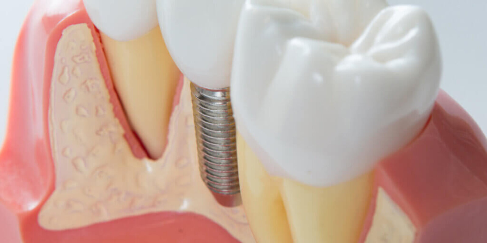 How to Keep Your Dental Implants in Good Condition