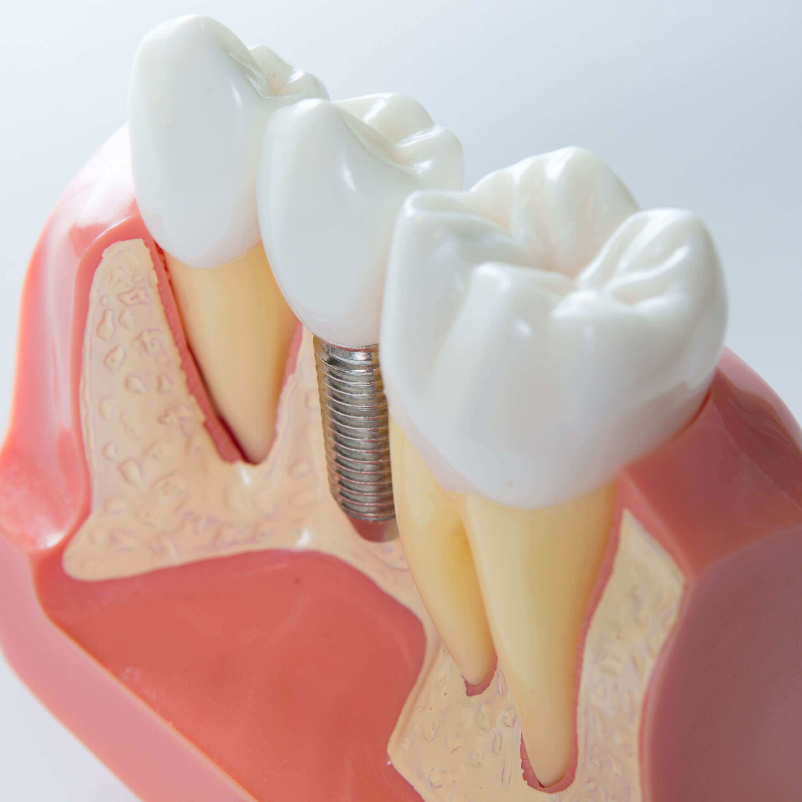How to Keep Your Dental Implants in Good Condition
