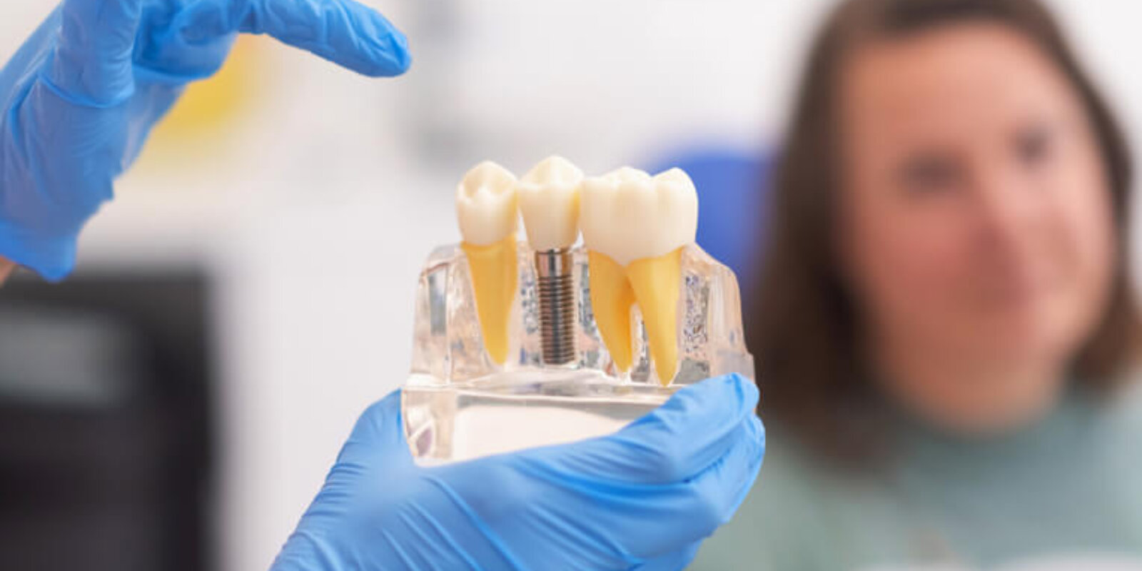 The Benefits of Dental Implants for Your Smile and Dental Health