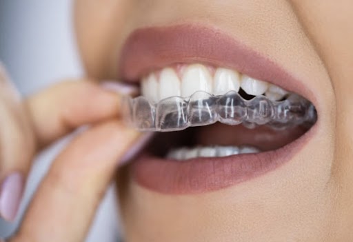 Invisalign treatment in Brockville
